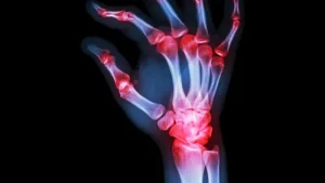 Potenziale dell'Ashwagandha nel trattamento dell'artrite reumatoide - Efficace attività antiossidante e antiartritica